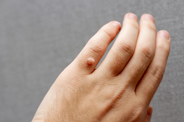 вірус папіломи людини на руці