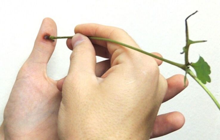 видалення бородавки на пальці соком трави чистотілу