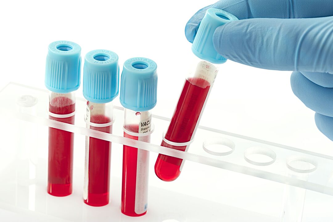аналіз крові для діагностики вірусу папіломи людини